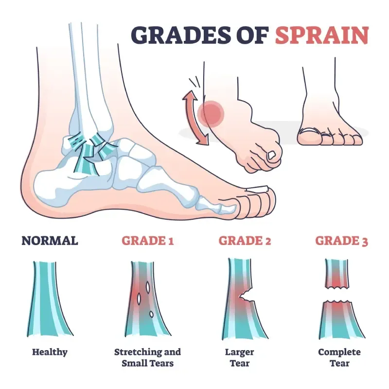 Ilustrasi Keparahan Kaki Keseleo